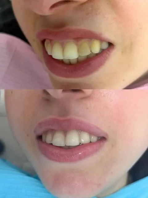 Antes y después de una sonrisa: arriba antes, abajo después
