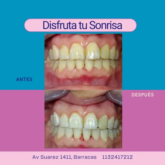 Antes y después de un tratamiento de estética dental