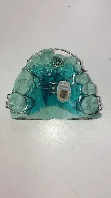 Aparato de ortodoncia con expansor sobre un modelo de yeso