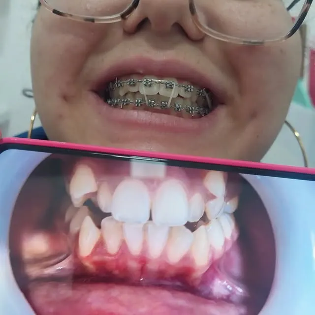 Paciente con ortodoncia fija y foto intraoral de los dientes